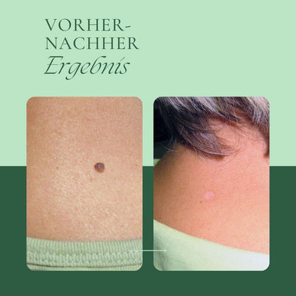 Creamole - Pflanzliche Creme zur Entfernung von Muttermalen, Leberflecken & Warzen