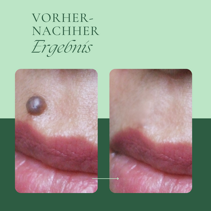 Creamole - Pflanzliche Creme zur Entfernung von Muttermalen, Leberflecken & Warzen